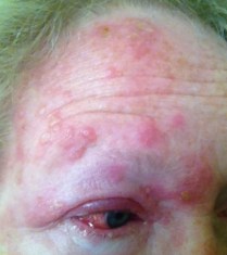 shingles_or_herpes_zoster_virus_attacking_forehead_and_eye